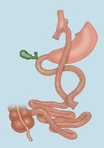 bypass-gastrico-final